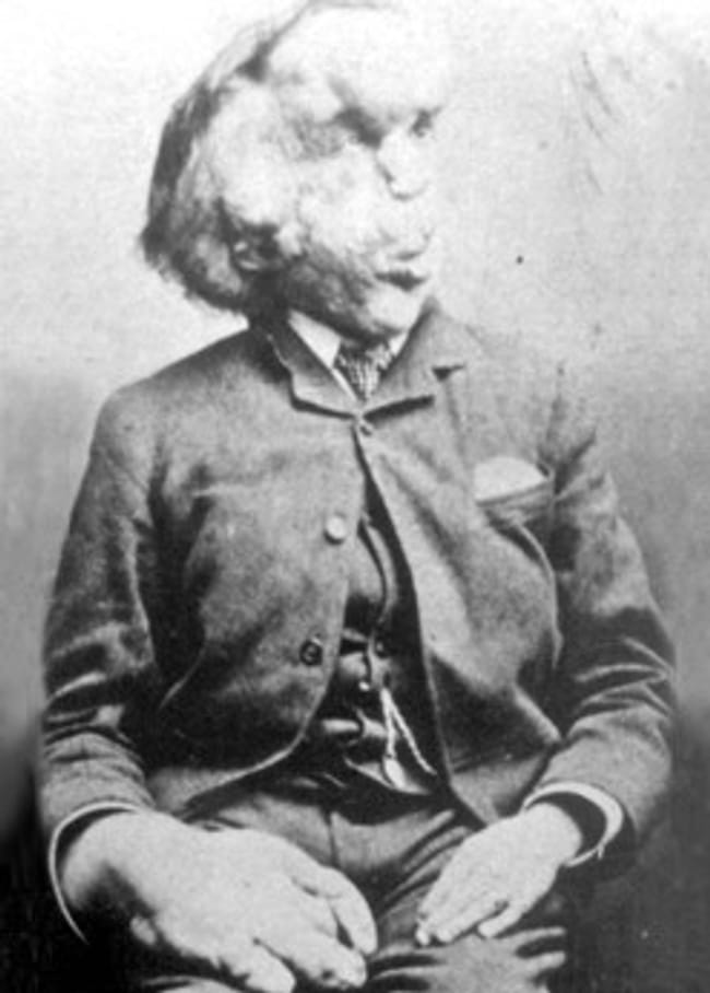 Joseph Merrick is listed (or ranked) 16 on the list 16 Famous People Who Probably Died as Virgins