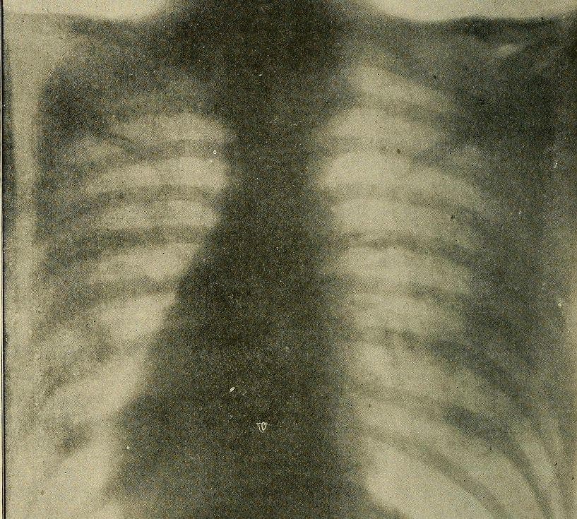 15 Terrifying Side Effects Of Body Piercings