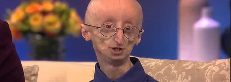 15 Fascinating Facts About Progeria The Rapid Aging Disease