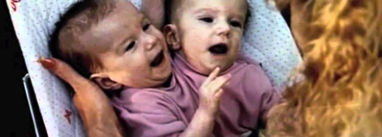 Things Most People Don T Know About Conjoined Sisters Abby And Brittany