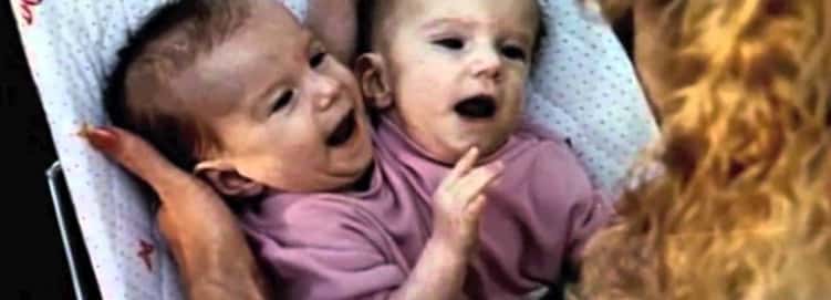 18 Things Most People Dont Know About Conjoined Twins 