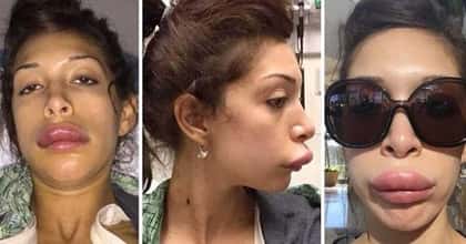19 Freaky Cases of Lip Injections Gone Wrong