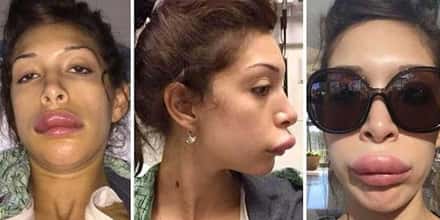 19 Freaky Cases of Lip Injections Gone Wrong