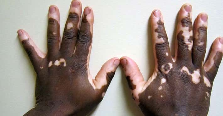 Vitiligo, Skin Without Pigment