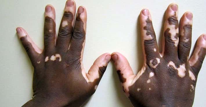 Vitiligo, Skin Without Pigment