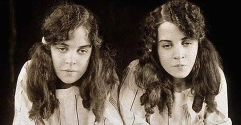 These Conjoined Twins Probably Lived The Most Tragic Lives