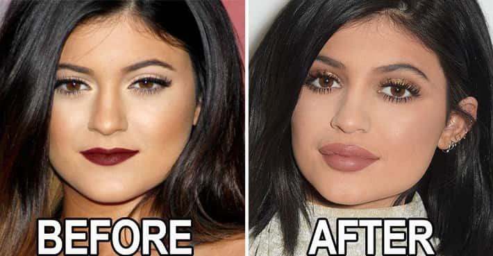 Before You Get Lip Injections