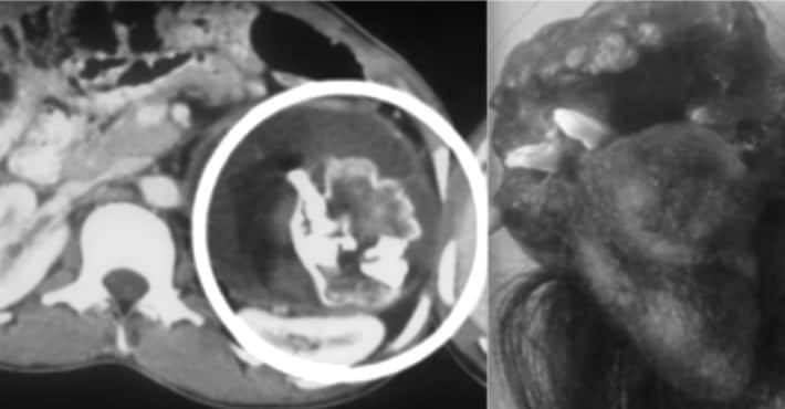 Parasitic Twins in Fetu Syndrome