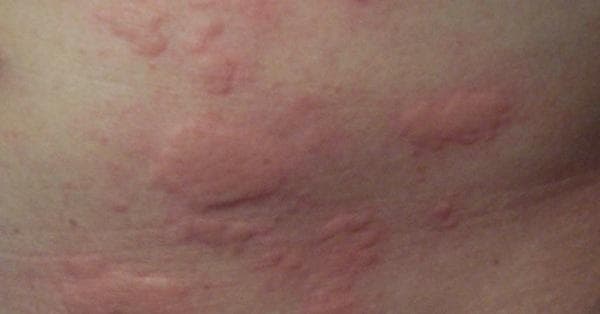 Eczema Symptoms | List of Signs of Eczema