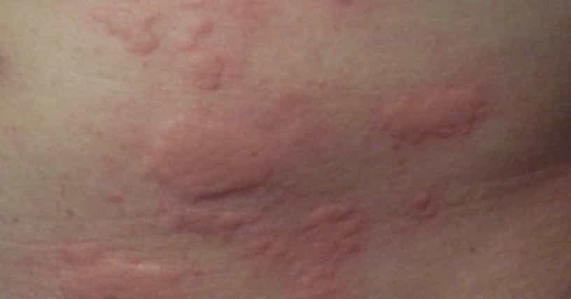 Eczema Symptoms List Of Signs Of Eczema