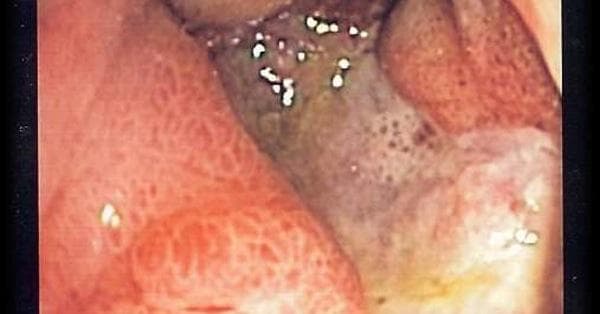 Peptic Ulcer Symptoms | List of Signs of Peptic Ulcer