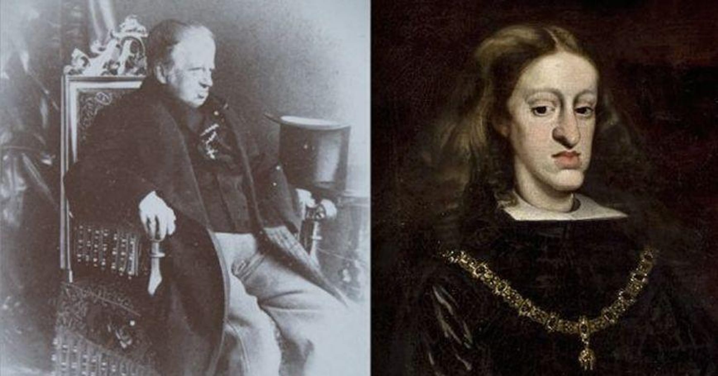 The Habsburg Jaw: deformity shaped by royal inbreeding