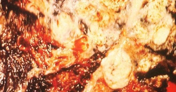 Famous People Who Died of Lung Cancer | List of Celebrity Lung Cancer