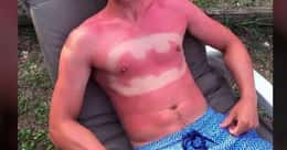 39 Epic and Painful Sunburns