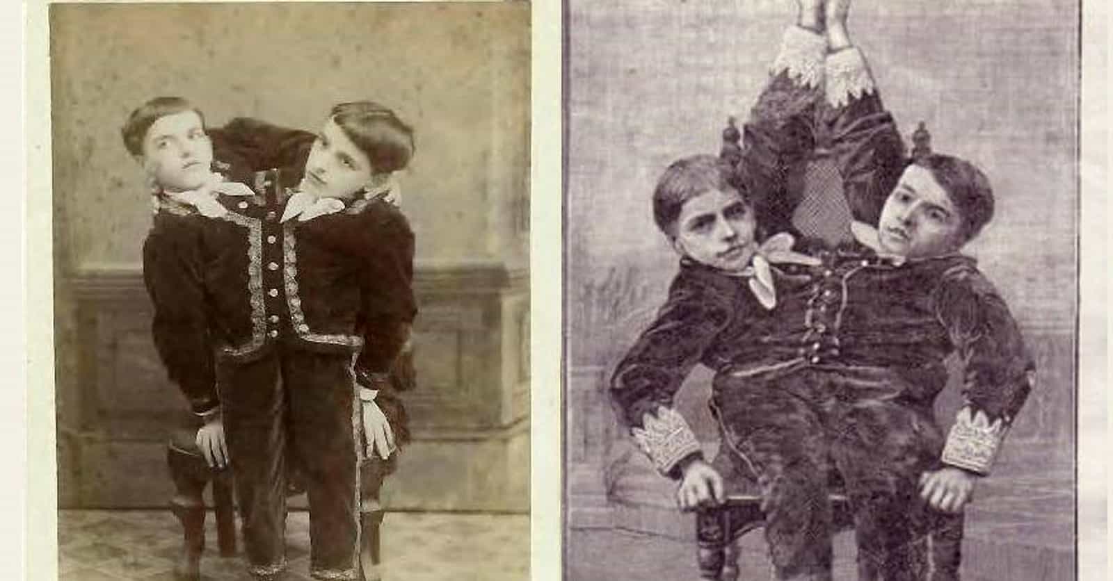 These Conjoined Twins Exploited Their Own Rare Condition To Get Rich And Completely Disappear