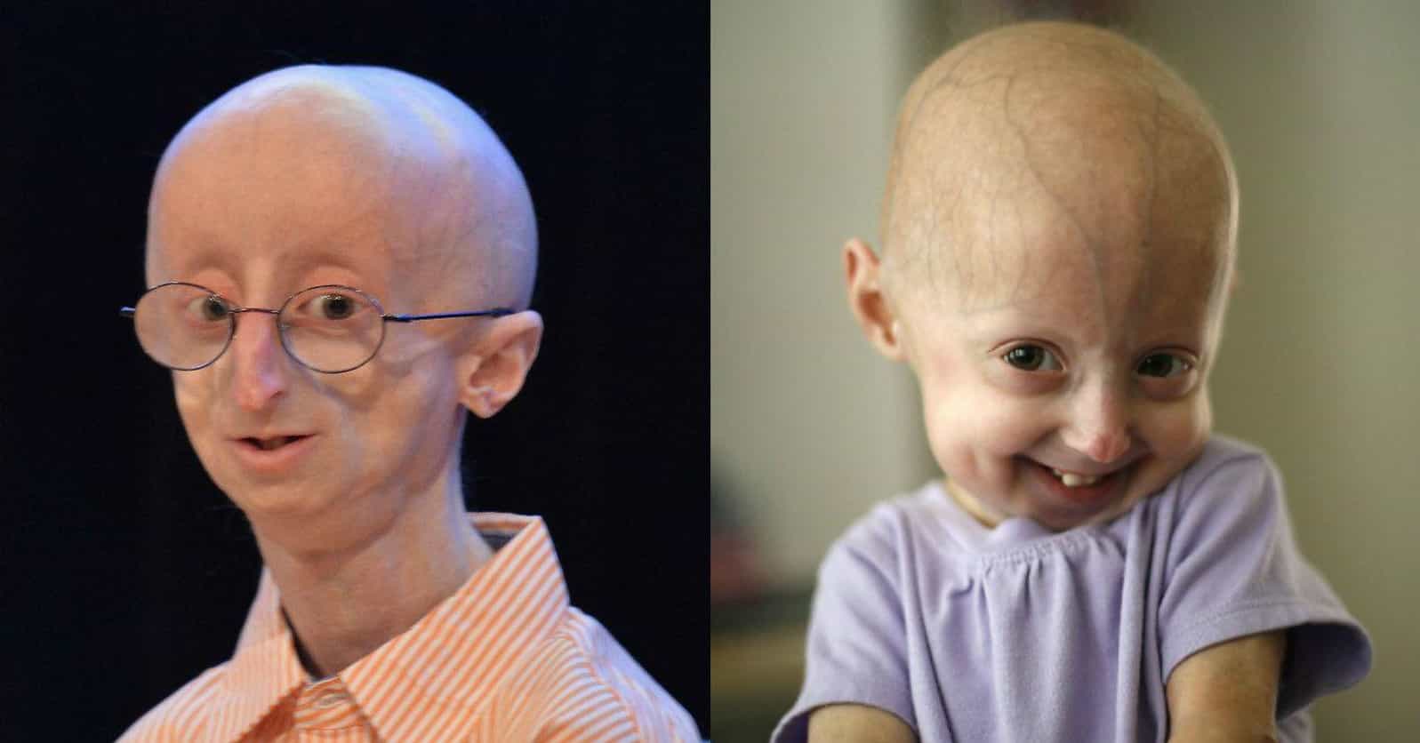 What You Need To Know About Progeria, The Disease That Rapidly Ages Young Kids
