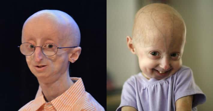 Progeria, Rapid Aging in Children