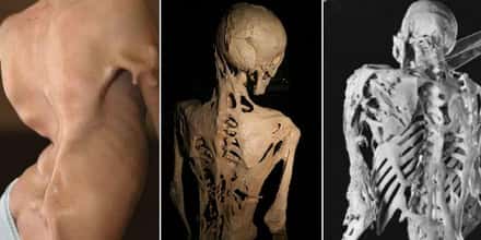 The Rarest And Most Gruesome Genetic Diseases Known To Science