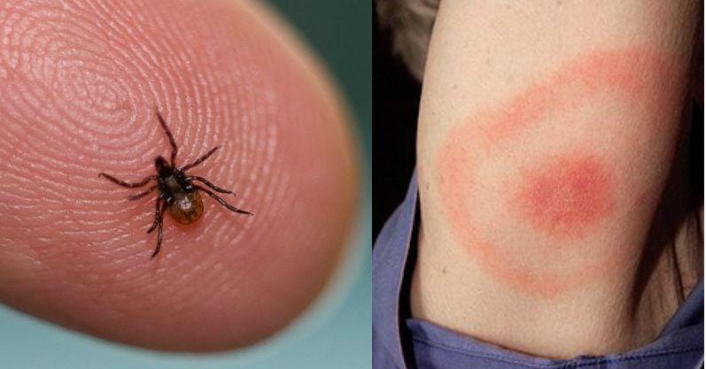 Everything That Happens to Your Body When You Get Lyme Disease
