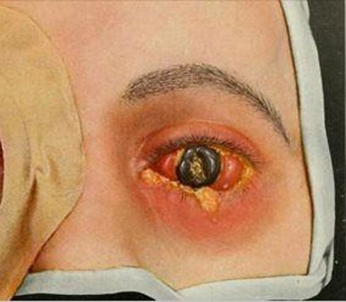 What It's Like to Die of Gonorrhea