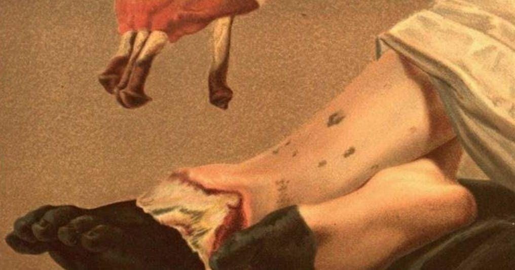10 Horrifying Facts About Dying From Gangrene