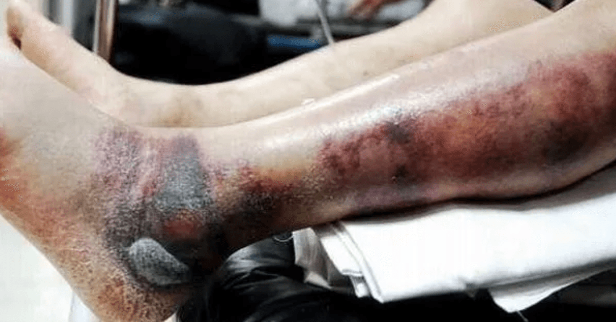 Alarming Facts About Flesh Eating Bacteria That'll Send You Straight To