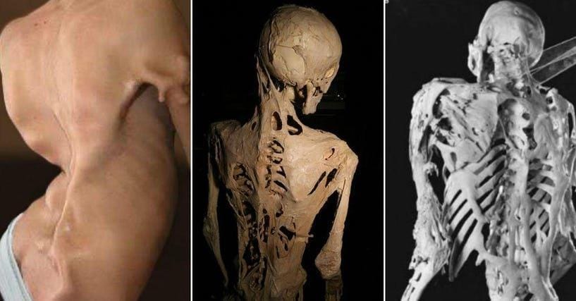 The 13 Rarest And Most Gruesome Genetic Diseases Known to Man