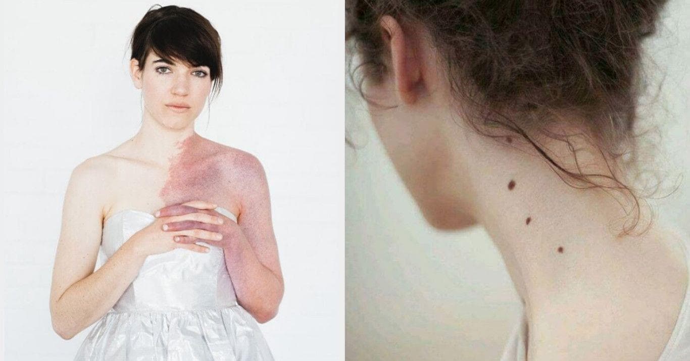 20 Rare And Bizarre Birthmarks You Need To See To Believe