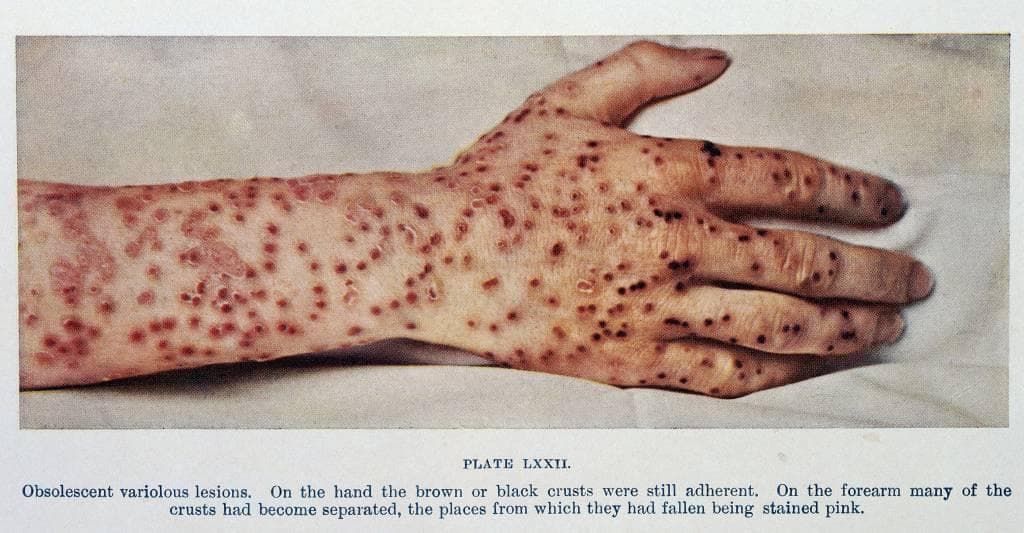 Smallpox Could Possibly Make A Comeback - But What Exactly Is It?