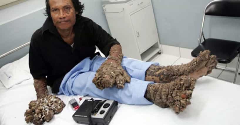 wash man q face Incurable Disease And Man Rare Tree Condition Is A wash man q face Incurable Disease And Man Rare Tree Condition Is A