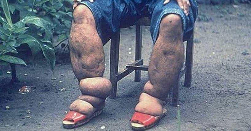 Grossest Things That Can Grow On Your Body | List Of Gross Diseases