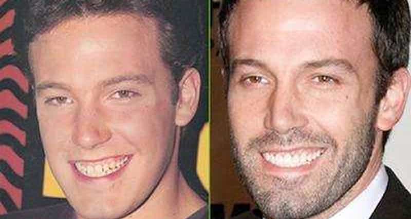 teeth fake celebrities dentures implants celebrity famous dental