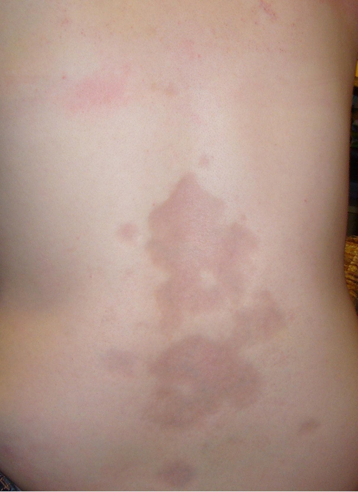 Rare Skins Diseases | List of Rare Skin Conditions