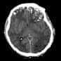 Traumatic brain injury is listed (or ranked) 10 on the list The Top 10 Ways I Would Kill My Boyfriend. . .