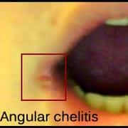 Angular cheilitis