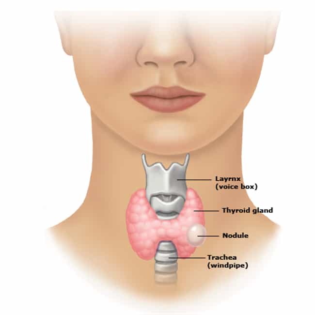 thyroid issues