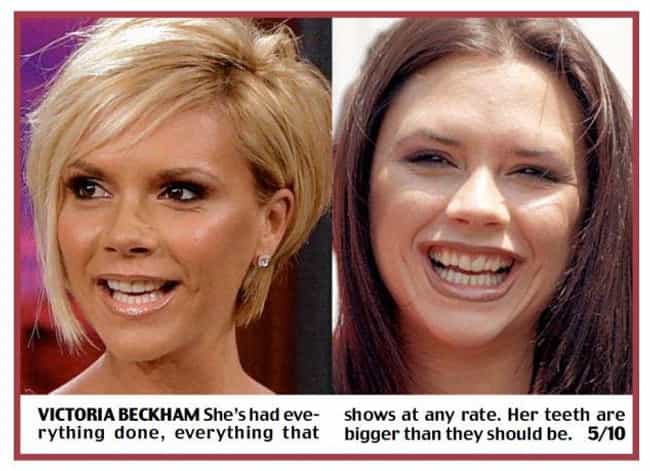 Celebrities with Fake Teeth | List of Famous People with Dentures and