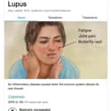 Lupus erythematosus on Random Weird Medical Drawings Google Thinks You Need