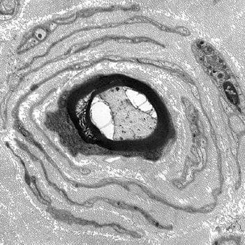 Dejerine–Sottas disease Rankings & Opinions