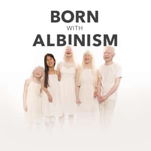 Born With Albinism