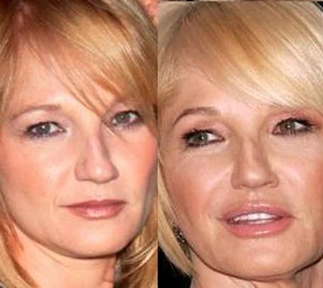 48 Celebrity Nose Jobs Before and After Cool Dump