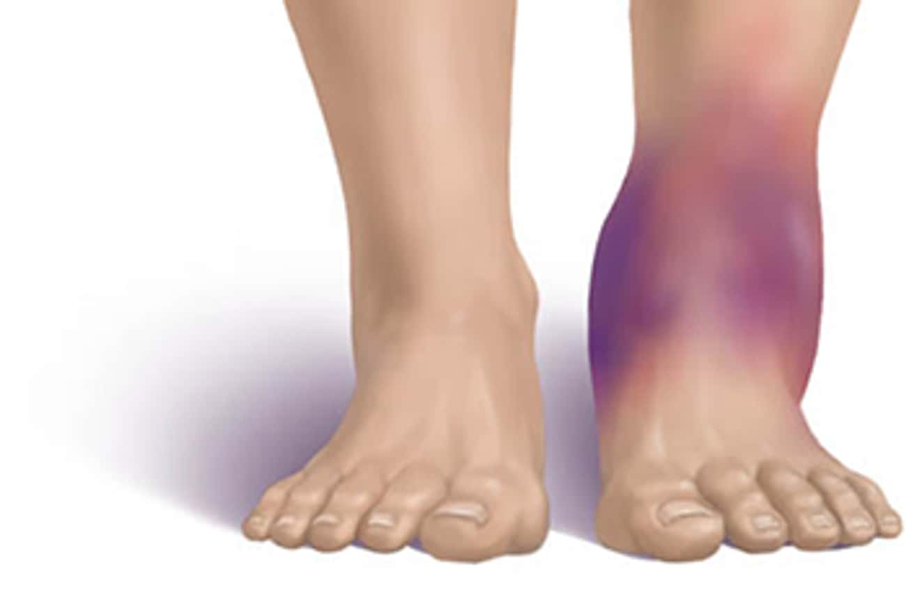 Почему нога фиолетовая. Рожистое воспаление голеностопного. Ревматоидный артрит голеностопного. Ревматоидный артрит голеностопного сустава.