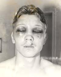 The Worst Boxing Injuries
