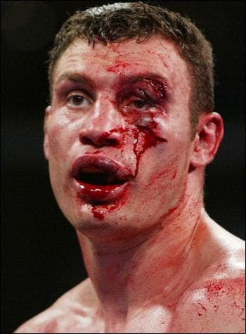 The Worst Boxing Injuries