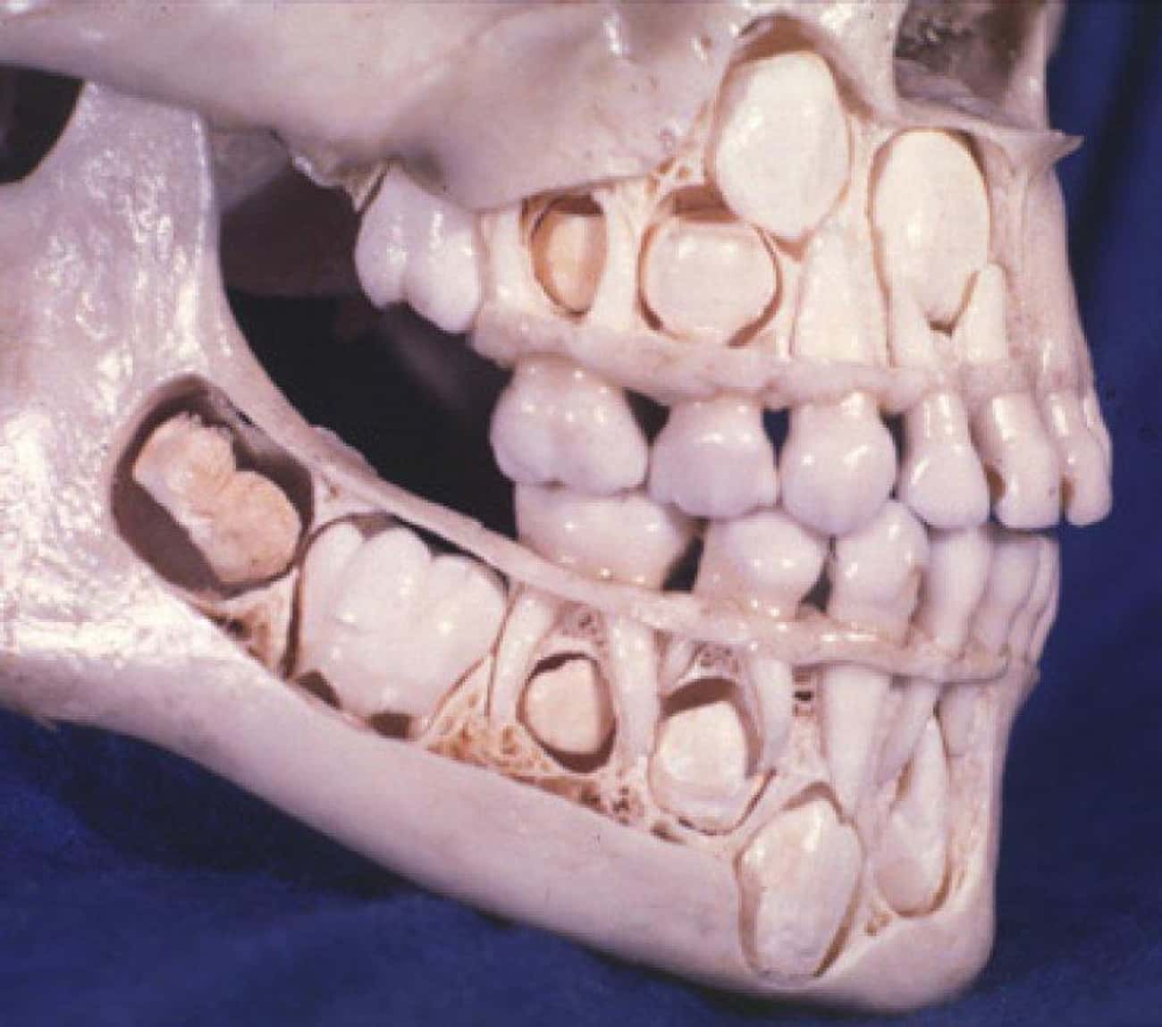 A Child's Skull Before Losing Baby Teeth