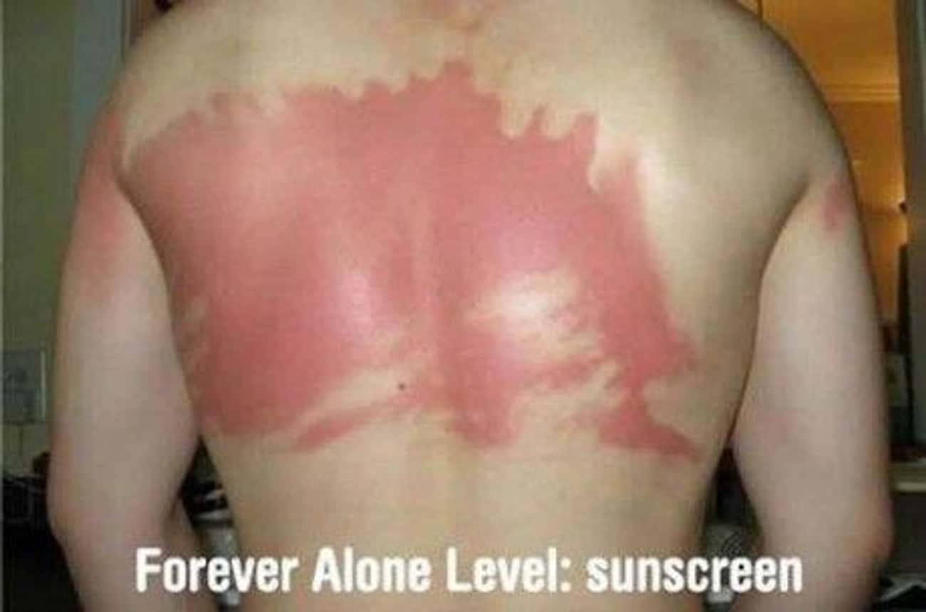 The Loneliest Sunburn Ever