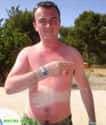 This Guy Who Sleeps With His Hand On His Belly on Random Epic and Painful Sunburns