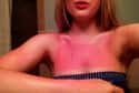 This Girl Who Forgets Parts Of Her Body Exist on Random Epic and Painful Sunburns