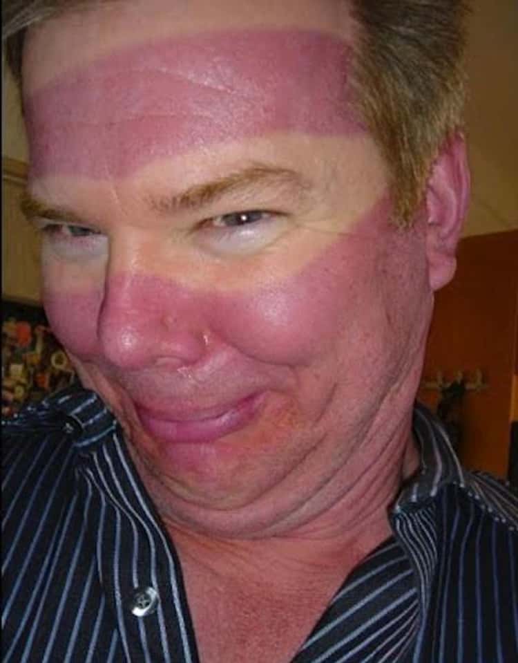 funny sunburn pictures