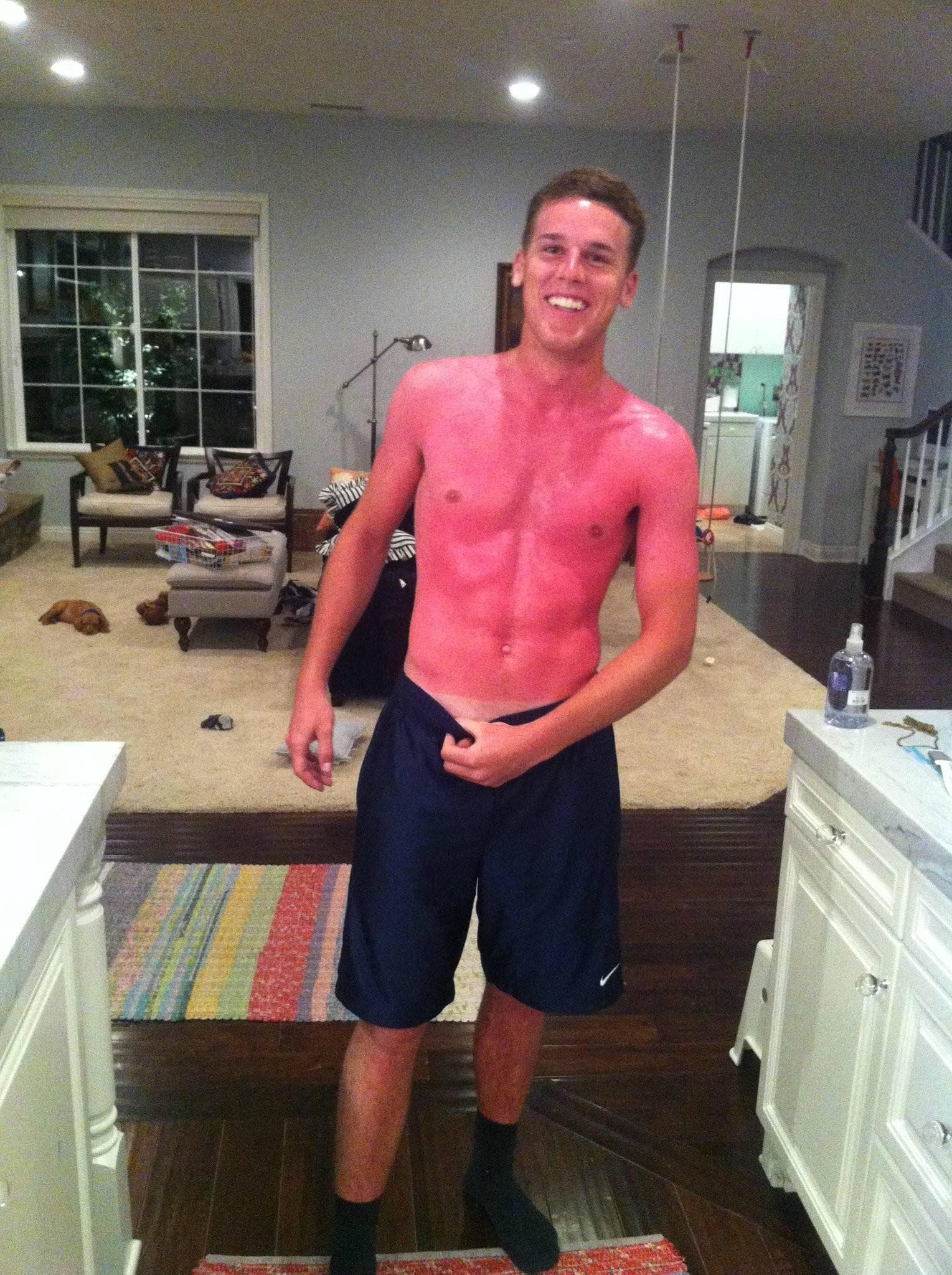 Обгорела на солнце фото Worst Sunburn Photos 39 Epic and Painful Sunburns